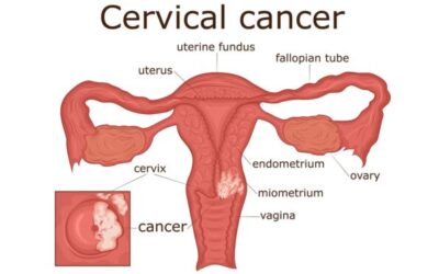 CERVICAL CANCER