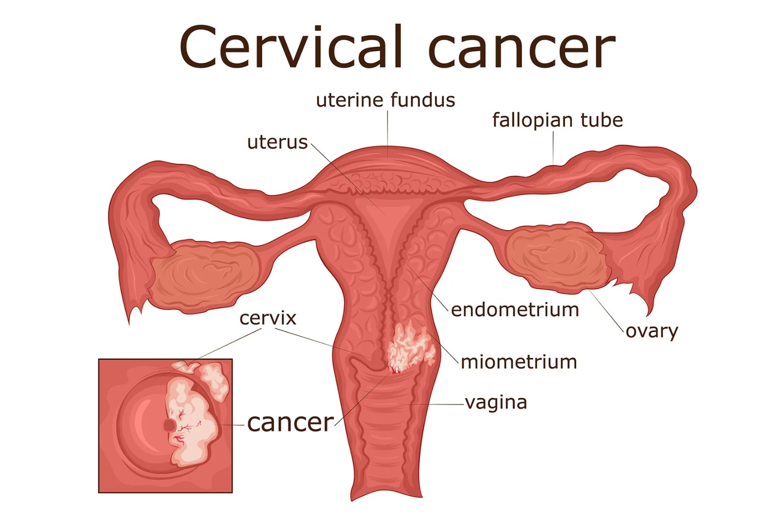 Cervical cancer: The preventable disease still claiming hundreds of thousands of lives
