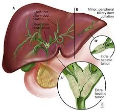 WHAT IS CHOLANGIOCARCINOMA?